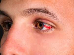 Subconjunctival Hemorrhage