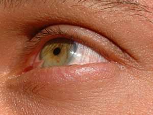 Pterygium