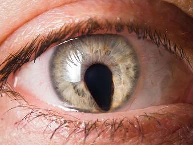 Iridocorneal Endothelial Syndrome