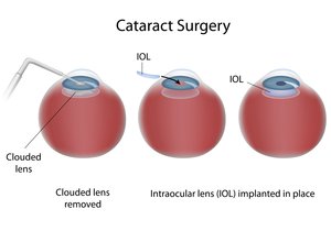 Faster Recovery - Cataract Surgery