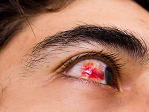 eye subconjunctival hemorrhage