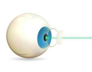 Laser Cataract Surgery