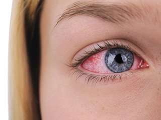 Conjunctivitis