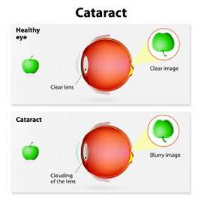 Difference between a healthy eye and cataracts 