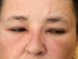 Puffy Eyes: What Causes Them and What To Do About It