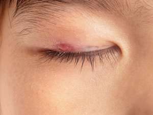 Eyelid surgery 