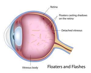 Flashers and Floaters