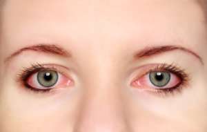 red-eye Man holding eye