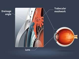 What is glaucoma 